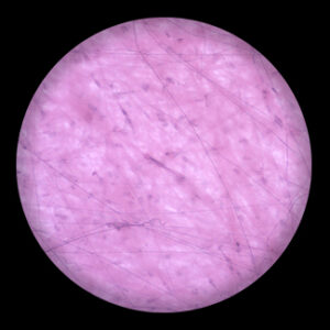 Laxity Connective Tissue